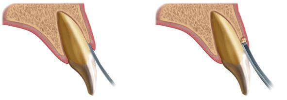 KB-1 Chisel
